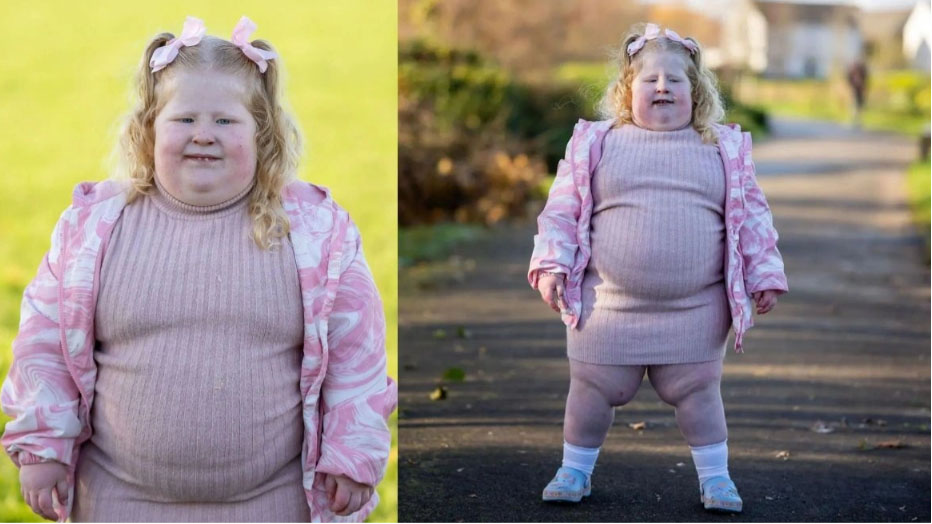 Britani e Madhe, vajza 5-vjeçare që peshon 45 kg vuan nga një sindromë që e bën vazhdimisht të uritur