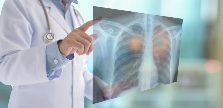 OBSH: Rritet numri i vdekjeve nga tuberkulozi në Evropë, një bakter sulmon kryesisht mushkëritë