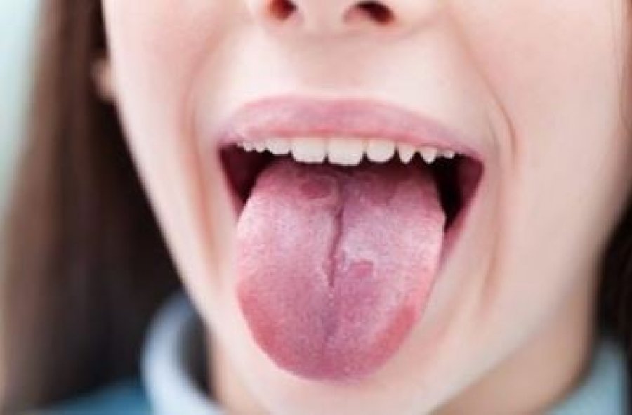 Mësoni për shkaqet dhe simptomat e tharjes së gojës, e njohur si Xerostomia