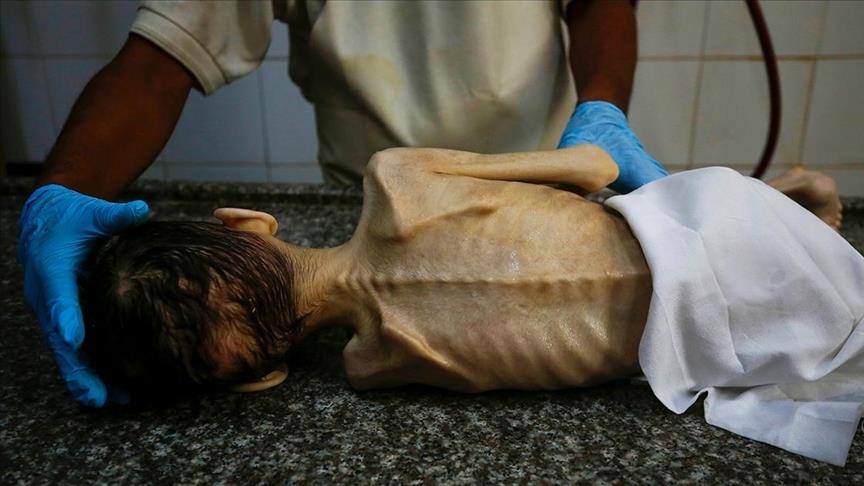 Një tjetër fëmijë vdes nga uria në Gaza