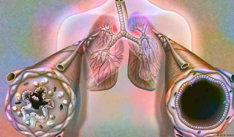 COPD/ Kur frymëmarrja bëhet gjithnjë e më e vështirë