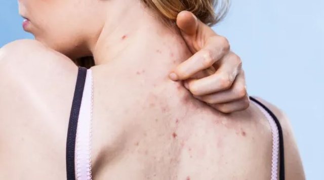 Çfarë është Hidradenitis suppurativa, sëmundja kronike e lëkurës dhe si ndikon në jetën e atyre që prek