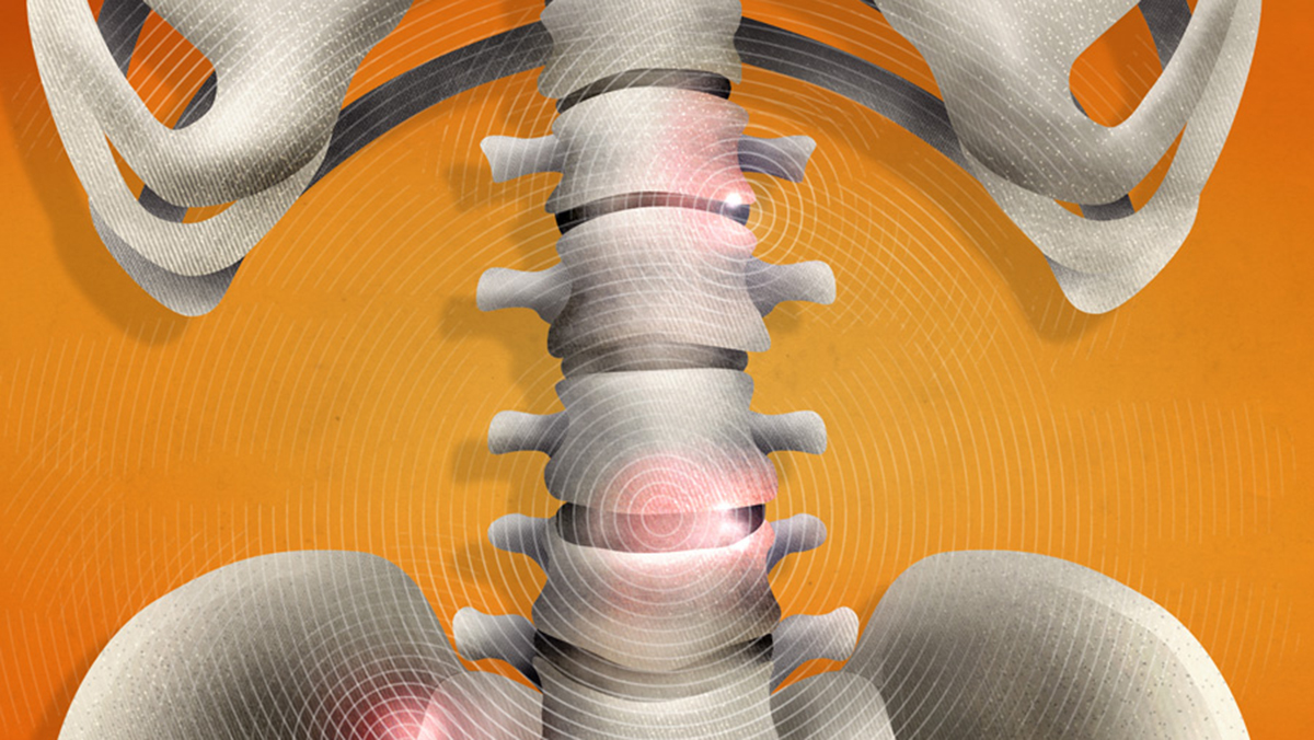 Çfarë është spondiloartriti? Sëmundja e pashërueshme që prek nyjat e shtyllës kurrizore, ja ç’duhet të dini rreth saj