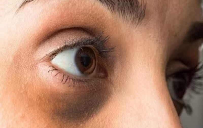 Menaxhimi i lodhjes dhe tendosjes së syve: 6 strategji për lehtësimin e simptomave