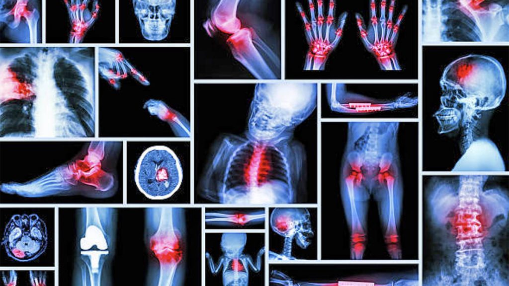 Si të përdorni qepët kundër artritit, reumatizmës dhe osteoporozës