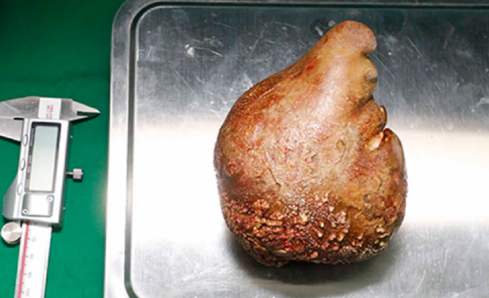 Një pacienti i hiqet guri më i madh në veshka ndonjëherë, me madhësi sa një portokall