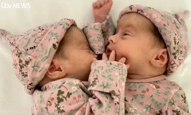  Lindën të bashkuara në një trup, dy binjaket ndahen përmes një operacioni të suksesshëm